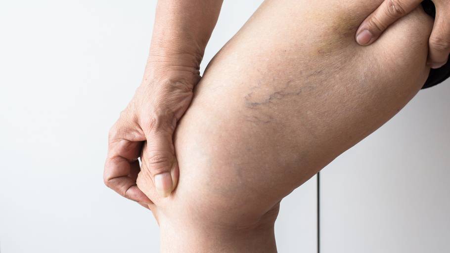 Offene Chirurgie der Vena saphena parva mit Krossektomie und Stripping: